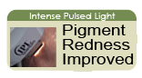 Intense Pulsed Light San Antonio